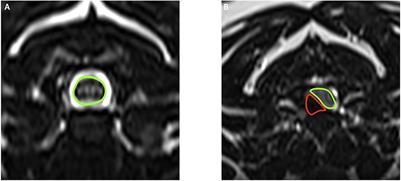 Association between spinal cord compression ratio in magnetic resonance imaging, initial neurological status, and recovery after ventral slot in 57 dogs with cervical disc extrusion